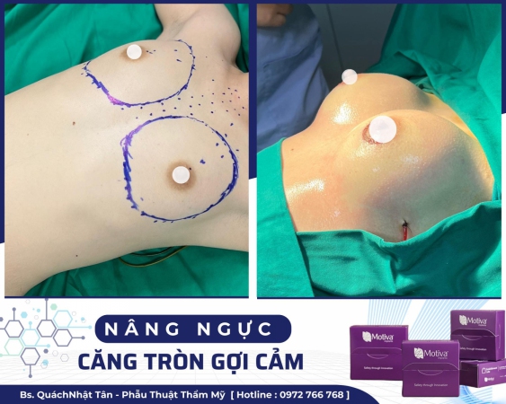 Nâng ngực nội soi: Bí quyết cho vòng 1 đẹp tự nhiên